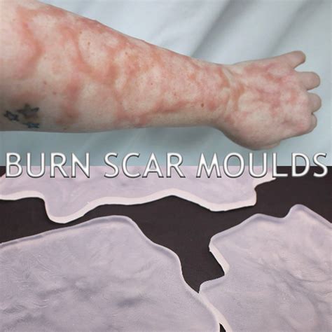 Healed Burn Scars Silicone Bondo Moulds Scarring Injury Wounds