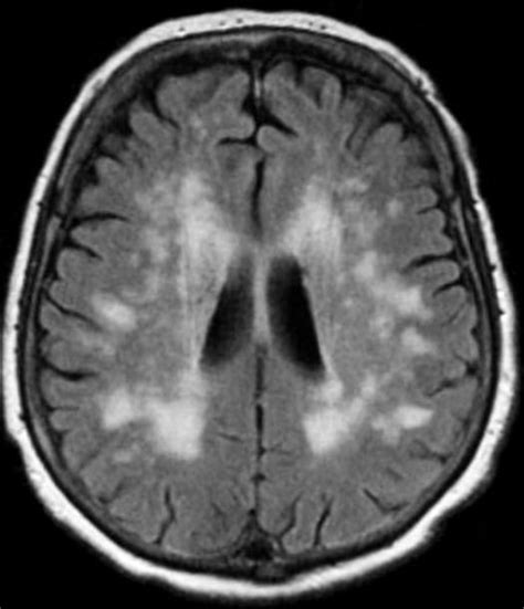Dr Balaji Anvekar Frcr Ischemic Stroke And Vascular Territories Of Brain