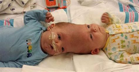 Conjoined Twins Finally Separated After Hour Surgery Us Abrozzi Com