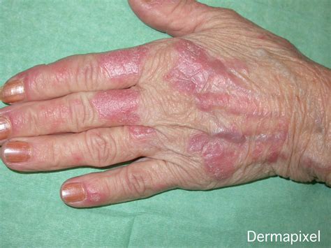 Top 115 Imagenes De Dermatitis En Las Manos Theplanetcomicsmx