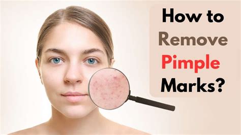 How To Remove Pimple Marks Reveal Your Natural Beauty With 15 Home