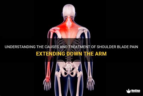 Understanding The Causes And Treatment Of Shoulder Blade Pain Extending
