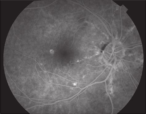 Window Defect In Fl Uorescein Angiography Due To Atrophy Of Rpe