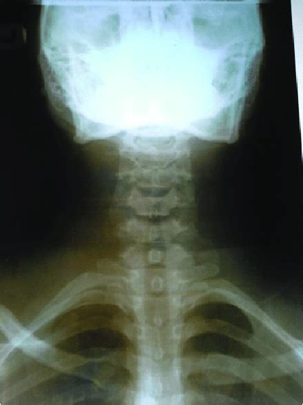 Anteroposterior Cervical Radiograph Showing Bilateral Cervical Ribs