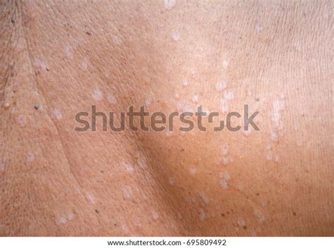 Photo De Stock Tinea Versicolorpityriasis Versicolor On Skin 695809492