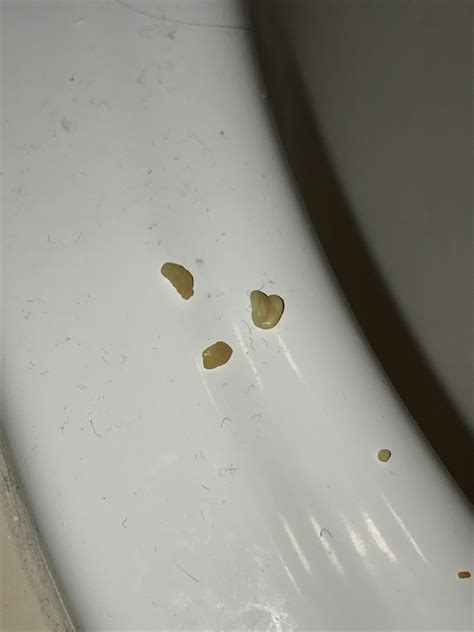 The Biggest Tonsil Stones Ive Ever Had Rpopping