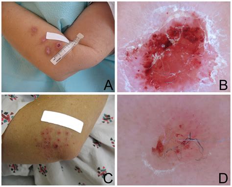 Representative Skin Lesions Detected On Clinical Examination A Three