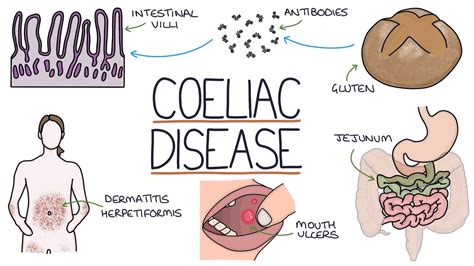 Understanding Coeliac Disease Youtube