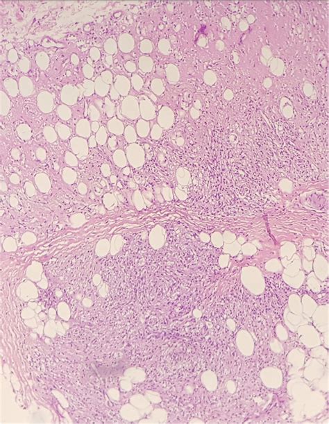 Histological Section Stained With Hematoxylin And Eosin Showing A