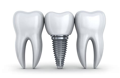 Santa Rosa Oral Surgeons Explain How A Dental Implant Preserves Your