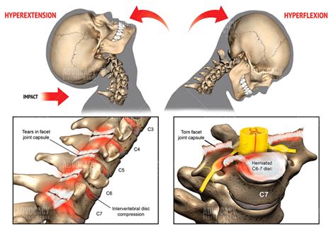 Can Osteopathy Help With Whiplash Better Health Osteopathy