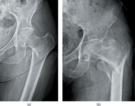 Extracapsular proximal femur fractures | Musculoskeletal Key