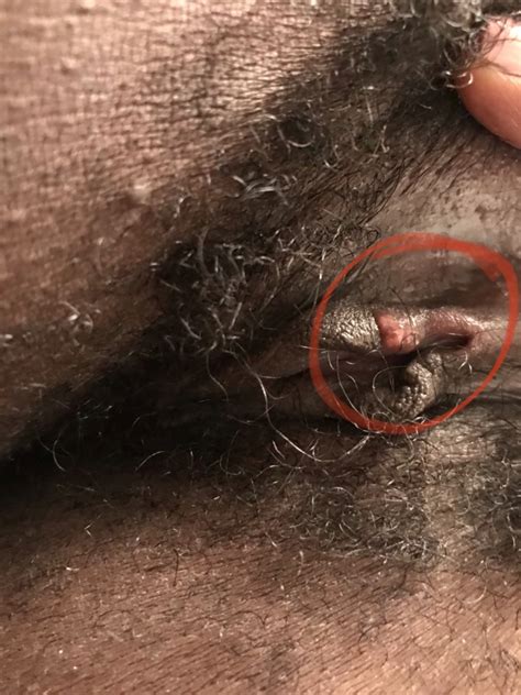 Help Is This Genital Herpes Or Something Else Pics