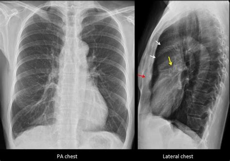 The term acute aortic syndrome (aas) is used to describe three closely related emergency entities of the thoracic aorta: 919 best images about THORAX on Pinterest | X rays ...