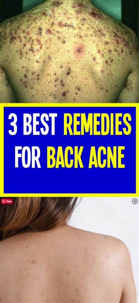 3 Best Remedies For Back Acne In 2020 Back Acne Remedies Remedies Acne