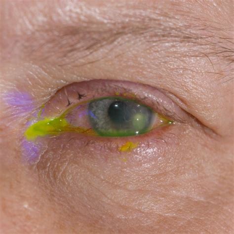 Eye Exam Periorbital Ecchymosis — Stock Photo © Arztsamui 77719452