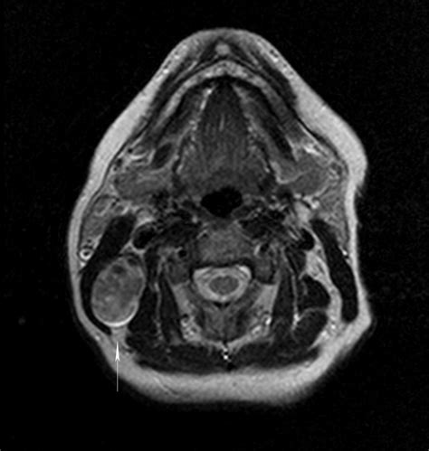 Pleomorphic Adenoma Arising From The Tail Of The Parotid Gland Value