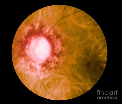 Retina Infected By Syphilis Photograph By Science Source Pixels