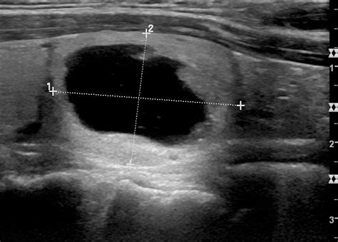 Thyroid Imaging Reporting And Data System Ti Rads A Users Guide