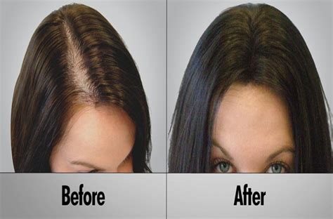 Hair loss refers to a loss of hair from the scalp or body. Best Hair Loss Treatment for Female