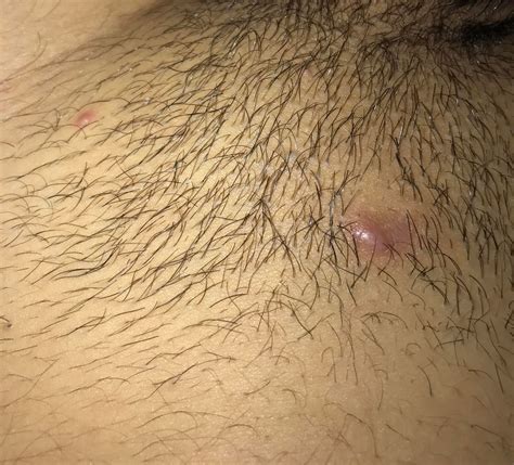 The hair strands will then sharpen, break down the surrounding epidermis, and form small red holes under the skin. Large Ingrown Hair Bump | Ingrown Hair