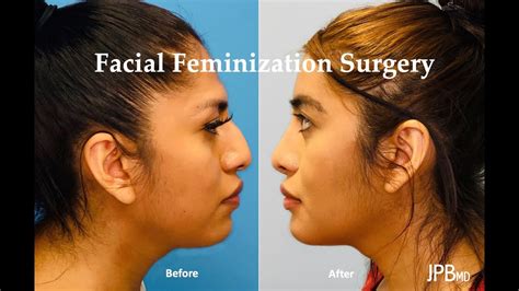 Facial Feminization Surgery YouTube