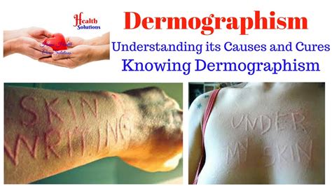 Dermographism Understanding Its Causes And Cures Youtube