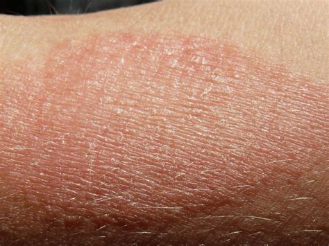 Deadly Symbols Of Skin Cancer You Must Spot Early Fajar Magazine