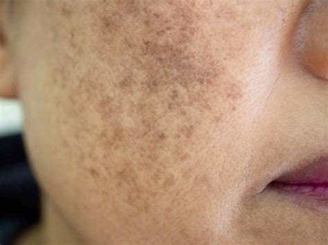 What You Need To Know About Melasma Victorian Dermal Institute