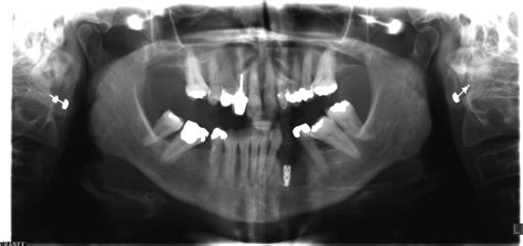 Floor Of Mouth Hematoma Following Dental Implant Placement Literature