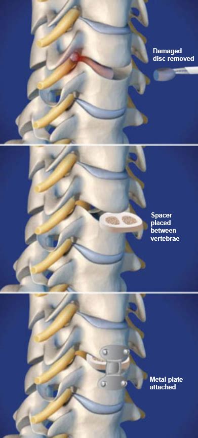 Anterior Cervical Discectomy And Fusion Central Coast Orthopedic Medical Group