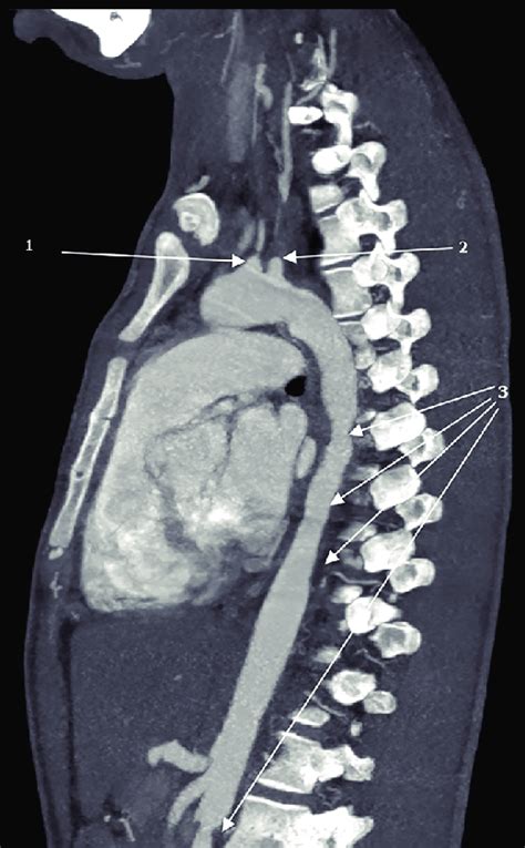 Computed Tomography Angiogram Of Thoracic And Abdominal Aorta
