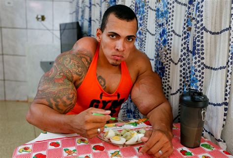 Bodybuilder Romario Dos Santos Alves Who Wanted To Be The Incredidble Hulk Injected His Arms
