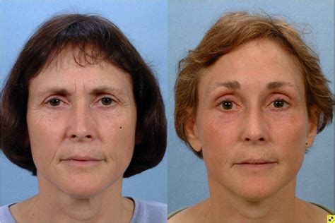 The solutions that are used contain special. Facelift and Mini-Facelift | Johns Hopkins Facial Plastic ...