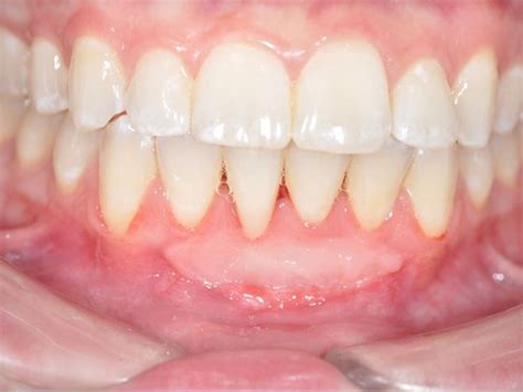 Olympia Patient Has Free Gingival Graft