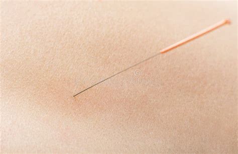 Acupuncture Stock Image Image Of Skin Needle Medical 54999639