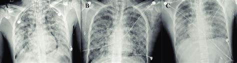 Serial Images Of Daily Chest Radiographs Taken During Patients Stay At