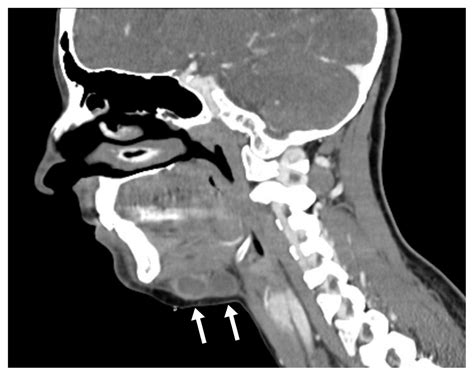 Disseminated Mycobacterium Bovis Infection Presenting With Cervical