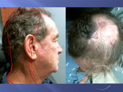 Scalp Scc Metastasis To Neck Skin Cancer And Reconstructive Surgery