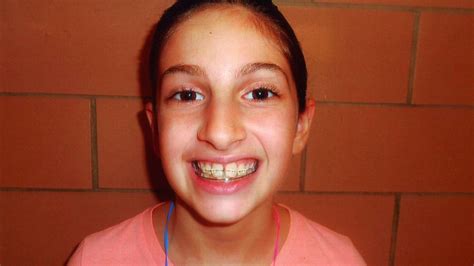 Pros And Cons Of Braces Newsday