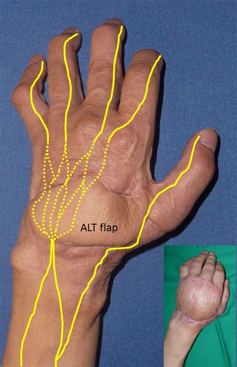 Treatment Of Hand Lymphedema With Free Flap Transfer And