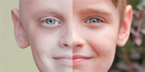 Striking Before And After Photo Illustrates Childhood Cancer Survivors