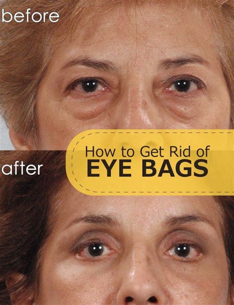 How To Get Rid Of Eye Bags Tips Park Eye Bags Treatment Eye Bags Under Eye Bags