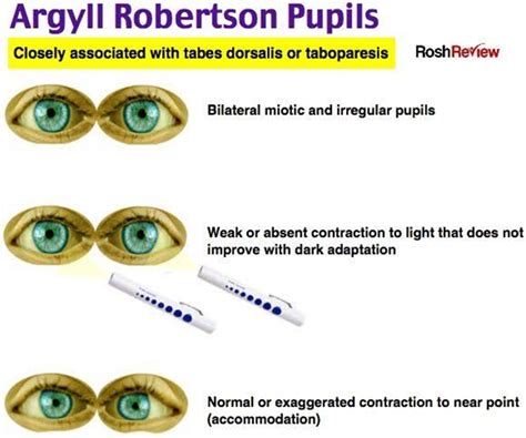 Pupillary Reflexes And Their Abnormalities Optography