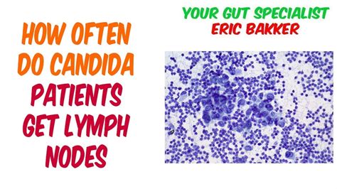 Do Candida Patients Often Have Swollen Lymph Nodes Youtube