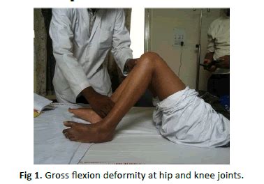 Fixed hip flexion contracture is a very common deformity present in adolescents or young adults who have cp and spend almost all their time sitting in a for many children, their primary adduction and abduction contractures or windblown deformities result from fixed hip flexion contractures, because. Total joint replacements in hip and knee ankylosed in ...