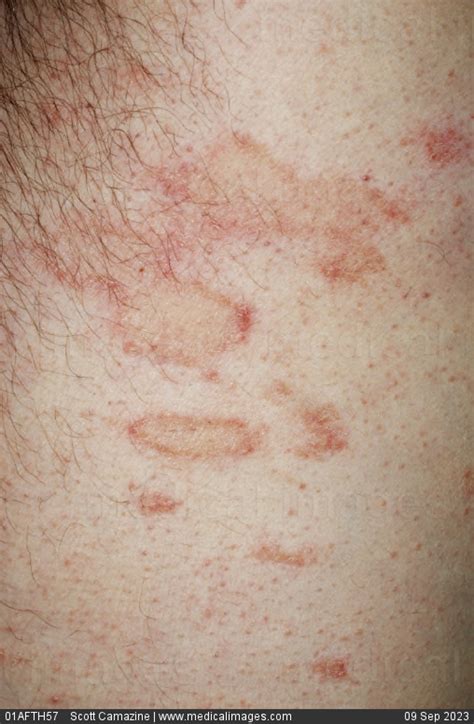 Atopic Dermatitis Rash On Legs