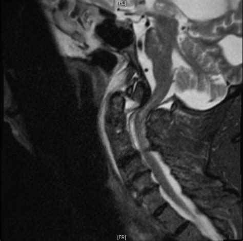 Odontoid Fracture Radiology