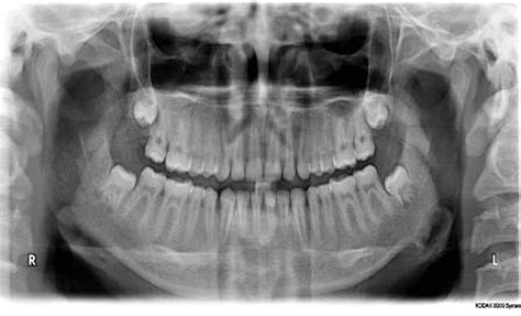 Osteoid Osteoma Of Mandible Bmj Case Reports