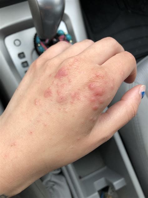What Are These Itchy Red Bumps On My Hand Offon For Several Months